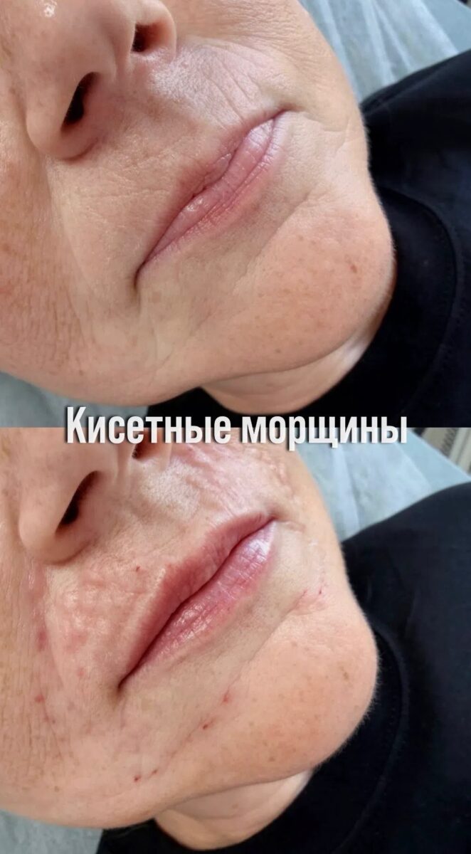 Лазерное омоложение, кисетные морщины