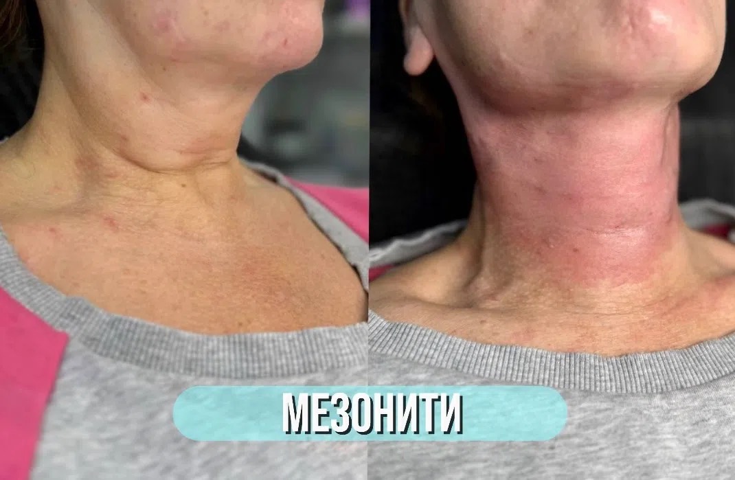 Мезонити, шея